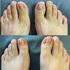 NeoClear™ COMPRE 2 Y RECIBA 5 -  ¡El dispositivo nº 1 contra los hongos de las uñas!